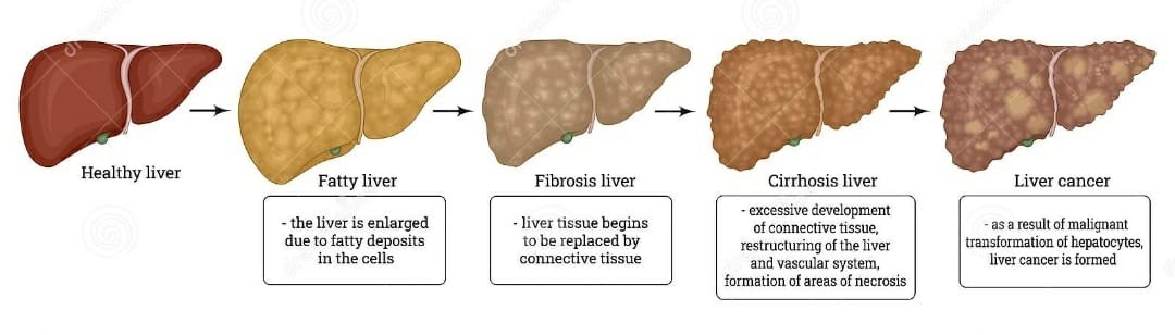 Fatty liver and obesity – an ongoing epidemic