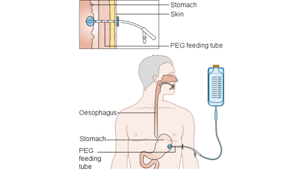 પીઇજી (PEG- Percutaneous endoscopic gastrostomy)