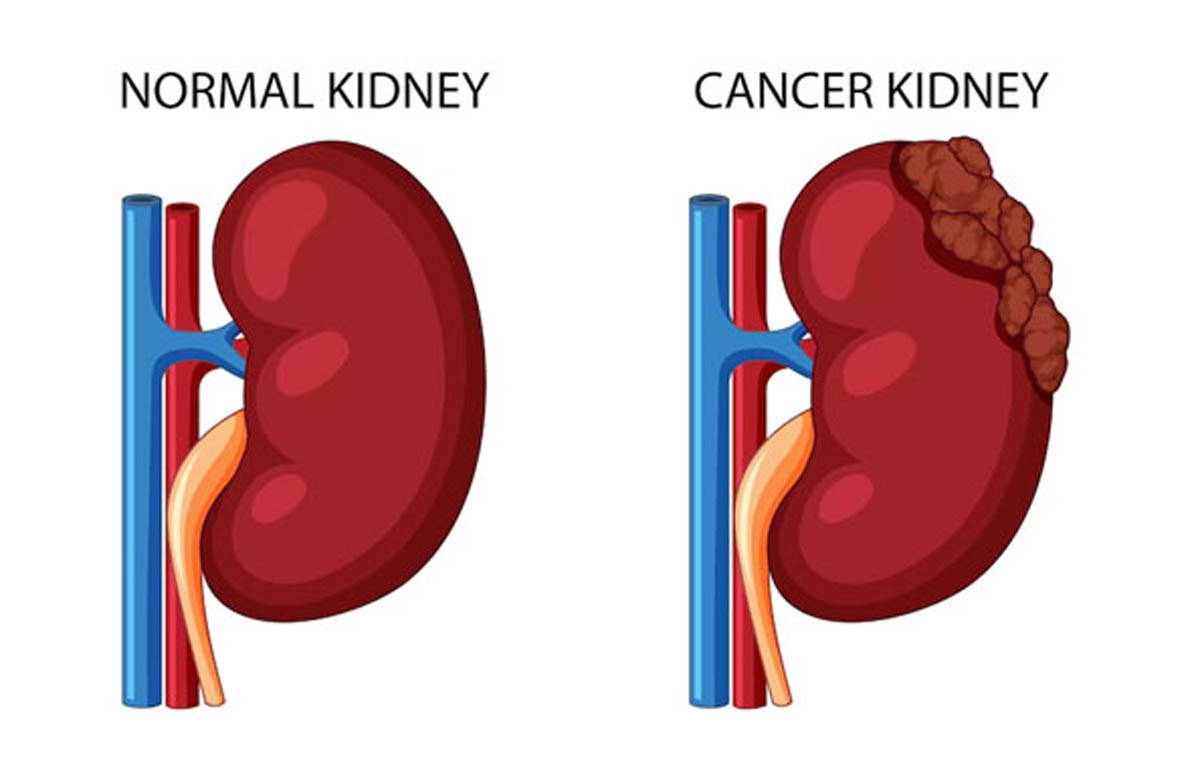 7 Signs of Kidney Cancer that You Should Know