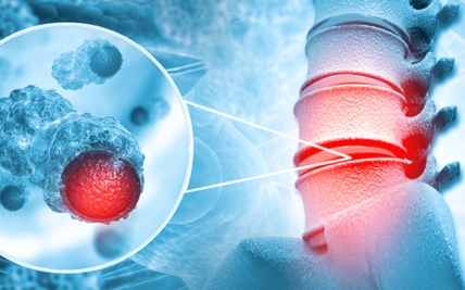 Bone Cancer