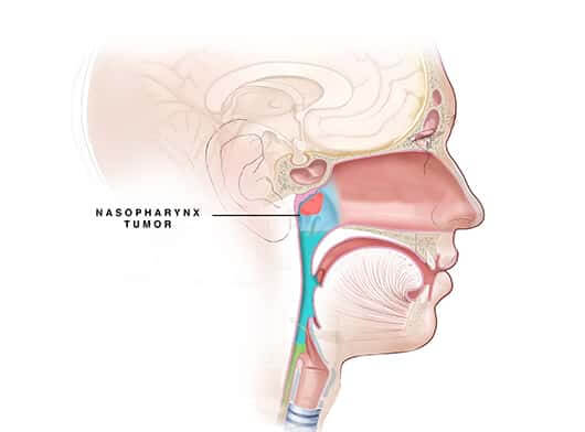 Nasopharynx Tumor