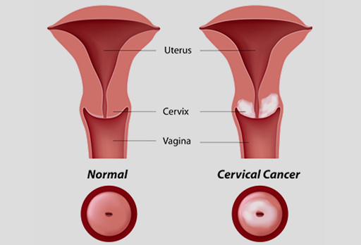 The Importance of Getting Screened for Cervical Cancer