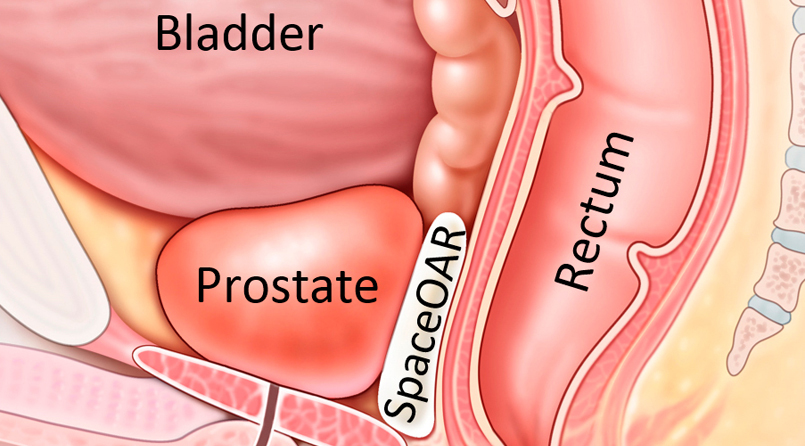 Treatment of Prostate Cancer