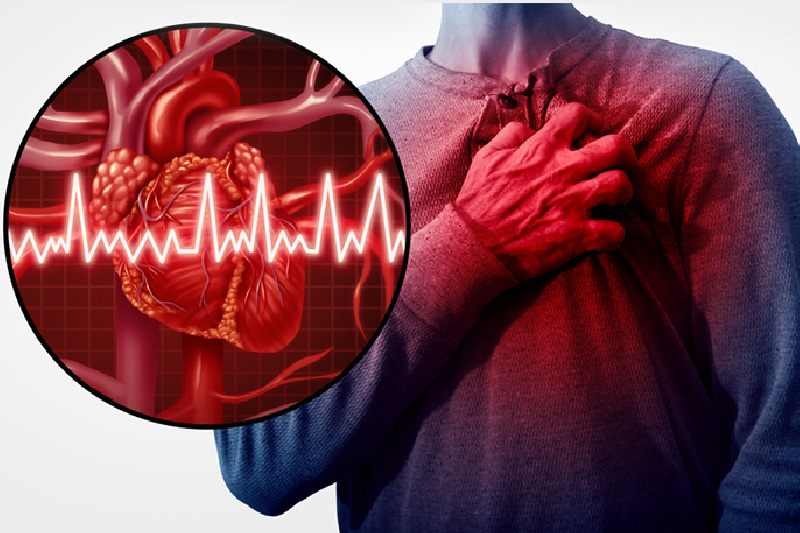 What Is Heart Attack or Myocardial Infarction (MI)?