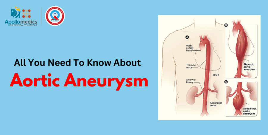 All you need to know about Aortic Aneurysm