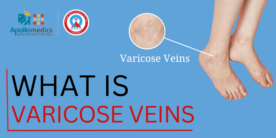 Varicose Veins Treatment in Lucknow