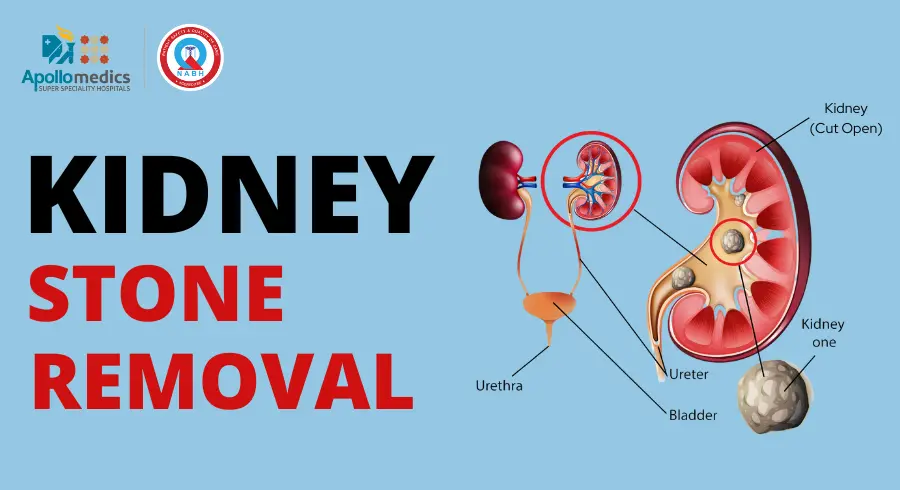 Best Hospital for Kidney Stone Removal