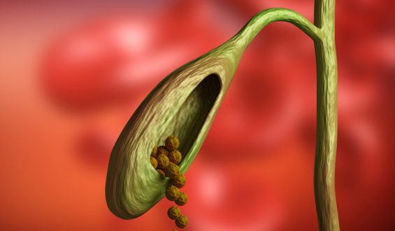 What are the consequences of having ones gall bladder removed, and what is the best solution for gall stones?