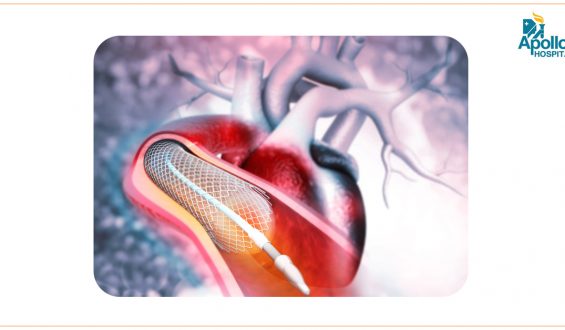 How is life after Coronary (Heart) Angioplasty with one Stent at the age of 46?