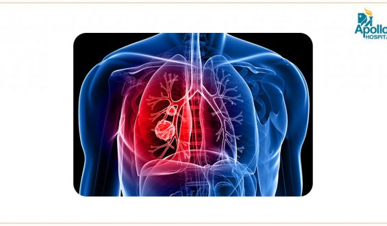 Is There a Cure for Lung Cancer?