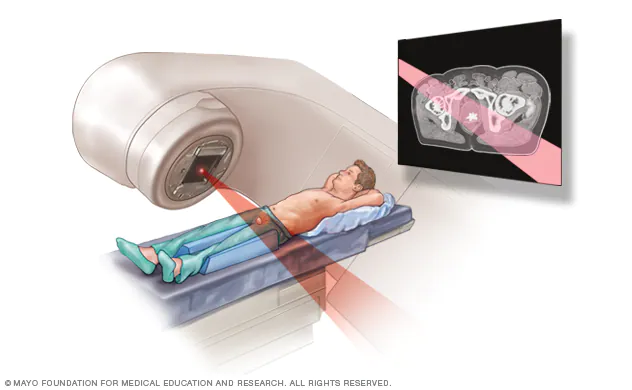 Radiation Therapy for Prostate Cancer: Understanding Options, Side Effects, and Advances in Treatment Radiation Therapy for Prostate Cancer: Understanding Options, Side Effects, and Advances in Treatment